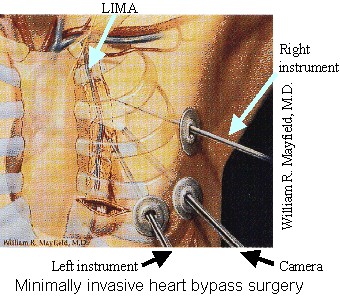 Minimally-Invasive Coronary Artery Bypass Grafting